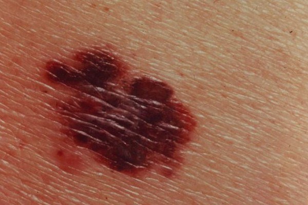 10 Deadly Signs Of Skin Cancer You Need To Spot Early Page 5 Health